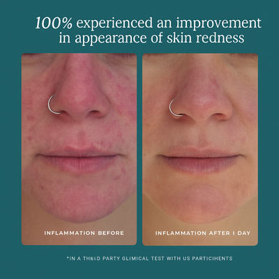 Vilora™ - Skin-Calming Hypochlorous Spray